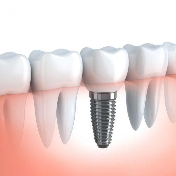 Implantologia – implant dentar
